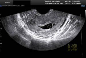 4 Weeks Pregnant Ultrasound: Pictures and Description | IYTmed.com