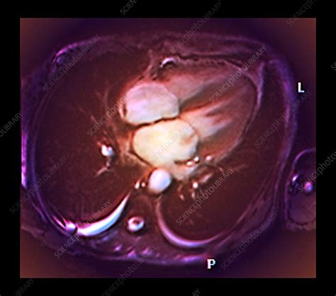 Leaking Mitral Valve