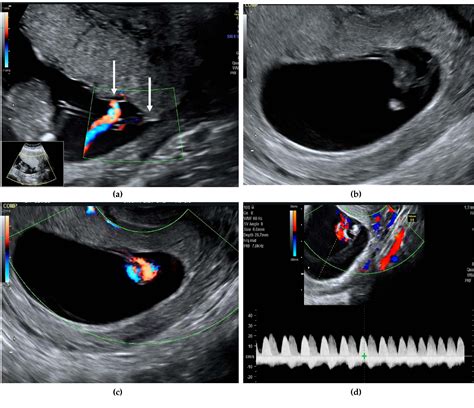 Figure 1 from Early Ultrasound Identification of Cord Entanglement in Monochorionic Monoamniotic ...