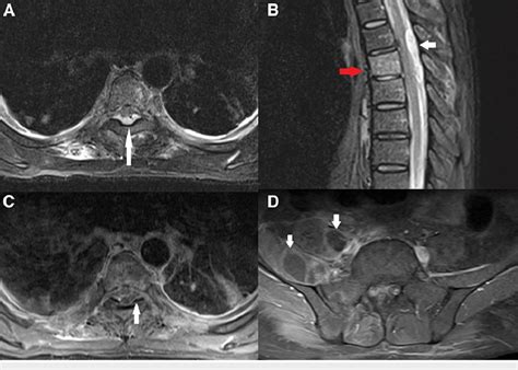 Magnetic resonance imaging of dorsal spinal cord. (A) MRI dorsal spine ...