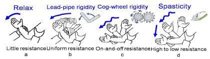 What are Spasticity and Rigidity? Spasticity - Rigidity Comparison ...