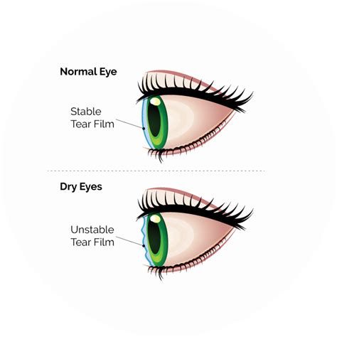 Common Eye Disorders- Symptoms And Treatment