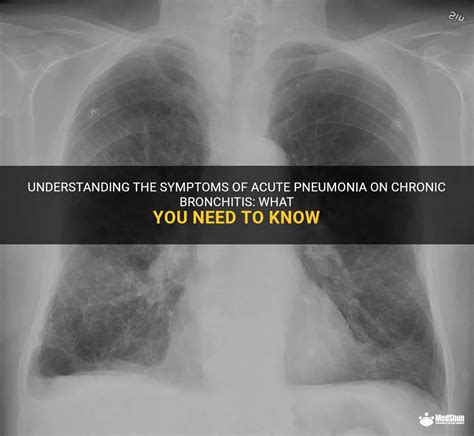 Understanding The Symptoms Of Acute Pneumonia On Chronic Bronchitis ...