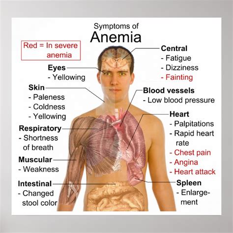 Symptoms Chart of the Blood Disease Anaemia | Zazzle.co.nz