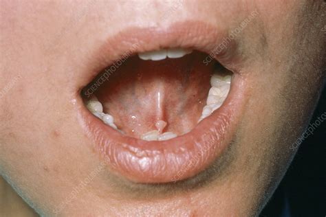 Pemphigus blister in the mouth - Stock Image - M240/0557 - Science Photo Library