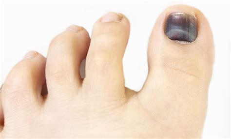 Can Diabetes Cause Toenails to Turn Black? » Scary Symptoms