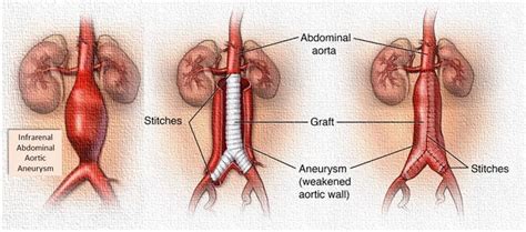 Abdominal Aortic Aneurysm: Open Repair