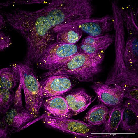 Biomolecular condensates forming in cancer cells | Nikon’s Small World