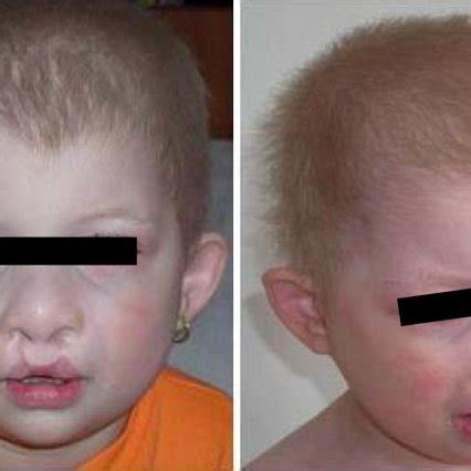 Clinical features of a 2-year-old boy with an ectodermal dysplasia ...