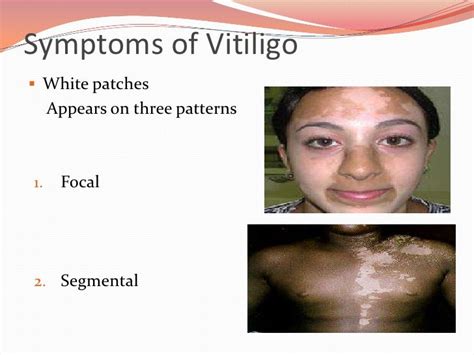 Vitiligo, causes and treatment