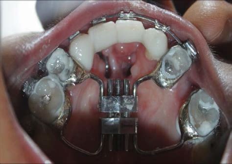 Treatment of severe maxillary cleft hypoplasia in a case with missing premaxilla with anterior ...