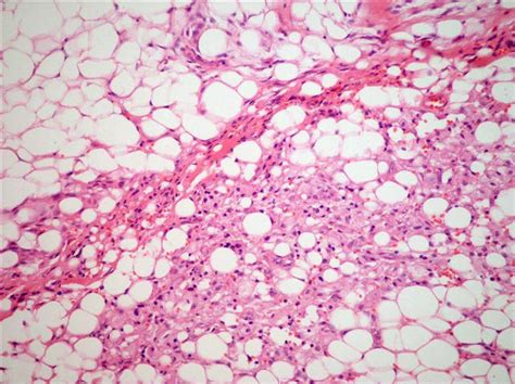 How Long Does A Colon Polyp Biopsy Results Take