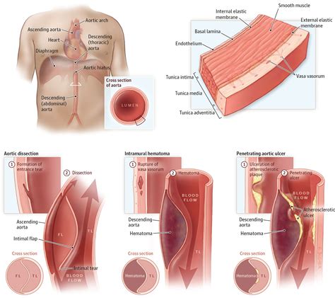 Aortic Dissection - Type A And B - Symptoms, Causes, Treatment