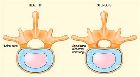 Spinal Stenosis and Disability - Chiropractor Houston Galleria Texas | Chiropractor Memorial ...