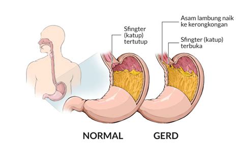 Penyakit Asam Lambung - Gejala, penyebab dan mengobati - Alodokter