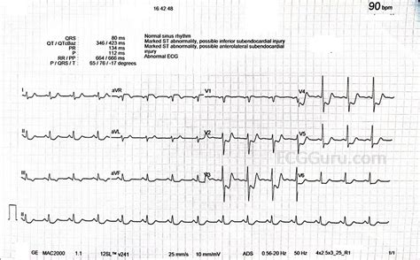 Severe Triple Vessel Disease | ECG Guru - Instructor Resources