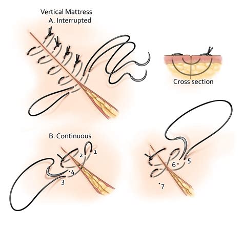 Top 99+ Pictures Types Of Surgical Stitches With Pictures Stunning 10/2023