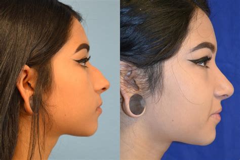 Nose Surgery Before & After Photos Patient 161 | San Francisco, CA | Kaiser Permanente Cosmetic ...