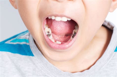 What Does A Cavity Look Like In Children