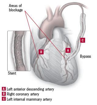 Bypass plus angioplasty: The best of both worlds? - Harvard Health