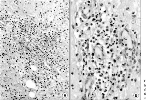 Figure 3 from Streptococcus Dysgalactiae Subspecies Dysgalactiae Infection after Total Knee ...