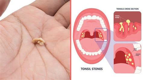 4 Things That Cause Tonsil Stones (And How to Prevent Them)