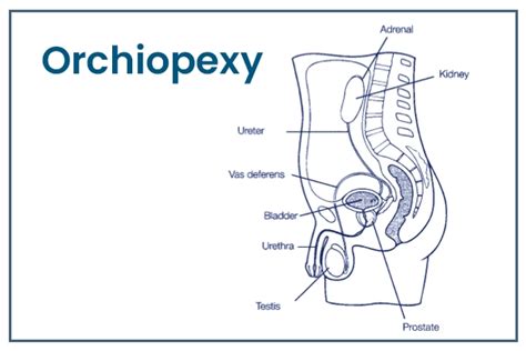 Pediatric orchiopexy surgery - Indications, Preparation & Recovery