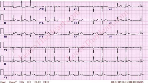 USMLE Step 2 - Cardiology Question 36 Answer | LearntheHeart.com