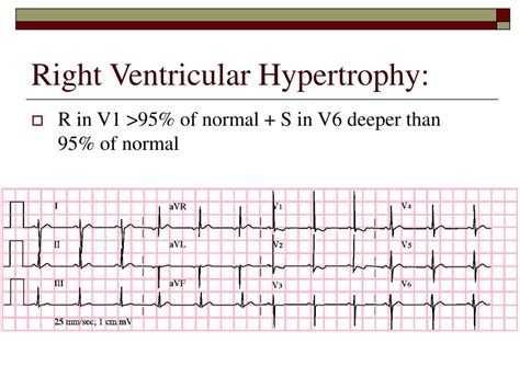 Right Ventricular Hypertrophy ECG Criteria