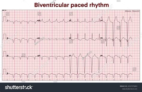 Biventricular Pacemaker Ecg