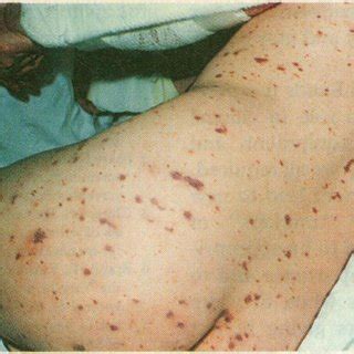 (PDF) Lesson of the Week: Who spots the spots? Diagnosis and treatment ...