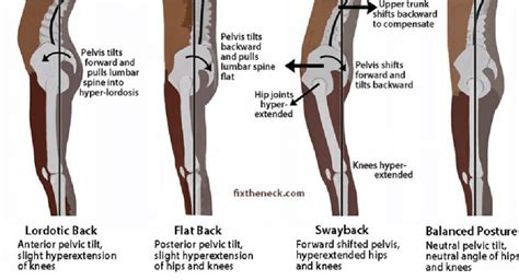 The Needed Pelvic Tilt to Gain Correct and Balanced Body Posture... | Download Scientific Diagram