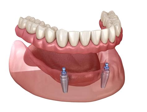 Implant Supported Dentures in Pitman, NJ