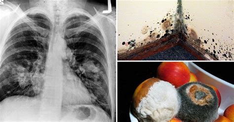 14 Signs Indicating On Mold Illness & How To Solve The Problem - Gotta Do The Right Thing