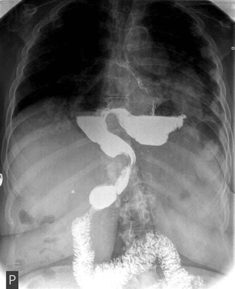 Barium swallow: image of upside-down stomach | Download Scientific Diagram