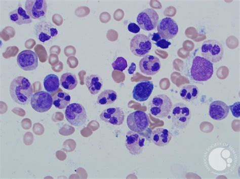 WHIM Syndrome aspirate