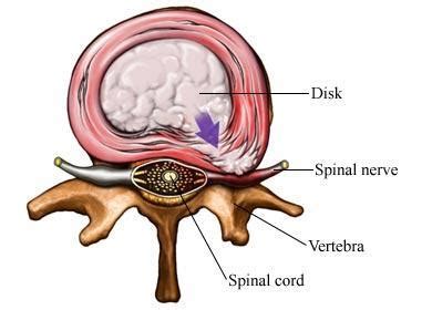 Disc Bulge With Annular Tear Treatment - Quotes Home