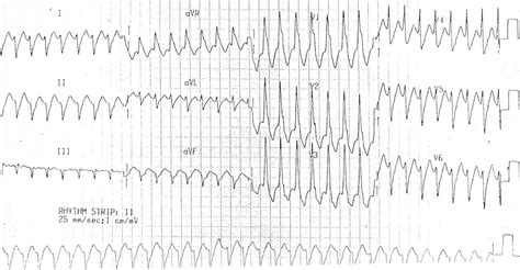 Monomorphic Vs Polymorphic Ventricular Tachycardia Strip