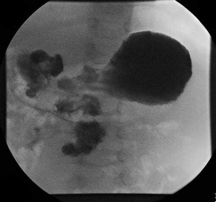 Intestinal malrotation | Radiology Case | Radiopaedia.org