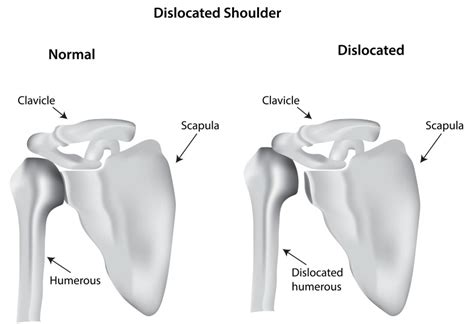 Shoulder Dislocation | Causes, Symptoms, Treatment & Braces