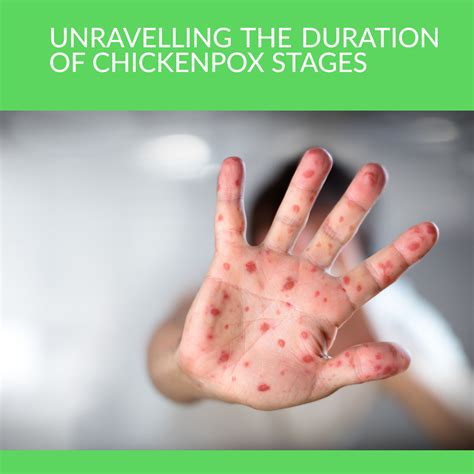 Understanding the Duration of Chickenpox Stages: A Comprehensive Guide — RiiRoo