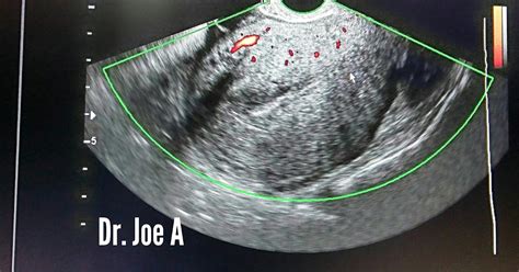 Ultrasound imaging: Adenomyosis uterus