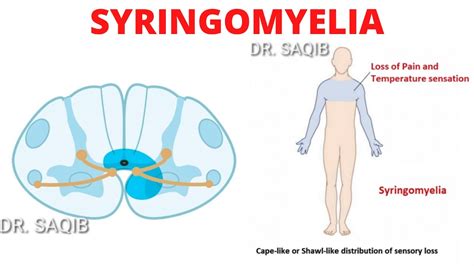 Syringomyelia - YouTube