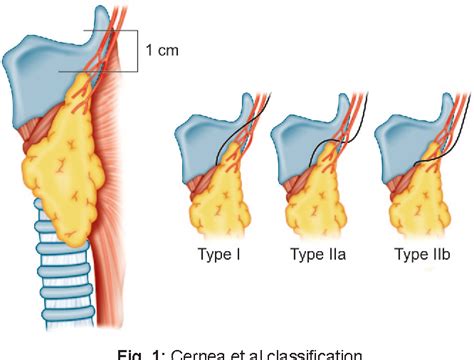 Figure 1 from Identification and Preservation of External Branch of Superior Laryngeal Nerve in ...