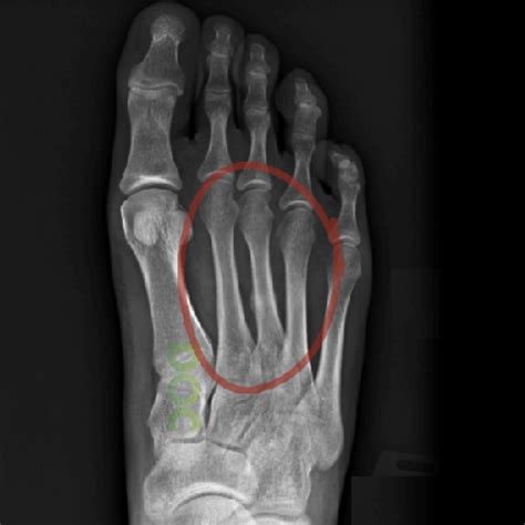 #356 What is periosteal reaction in a stress fracture - DOC