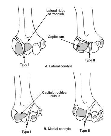 Distal Humerus Fractures - Trauma - Orthobullets