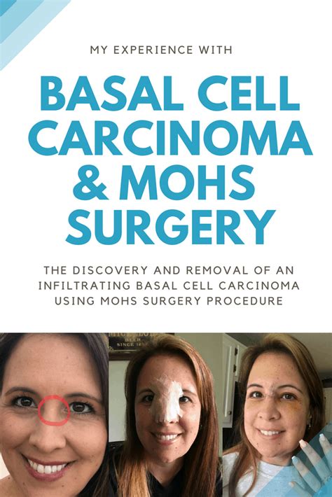 Basal Cell Carcinoma + Mohs Surgery - Moscato Mom