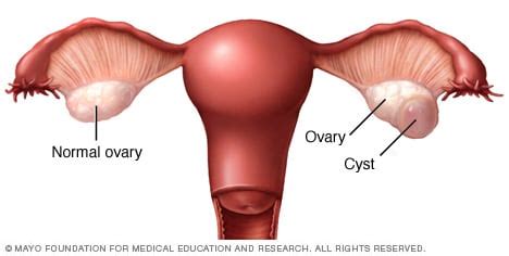 Ovarian cysts - Symptoms and causes - Mayo Clinic