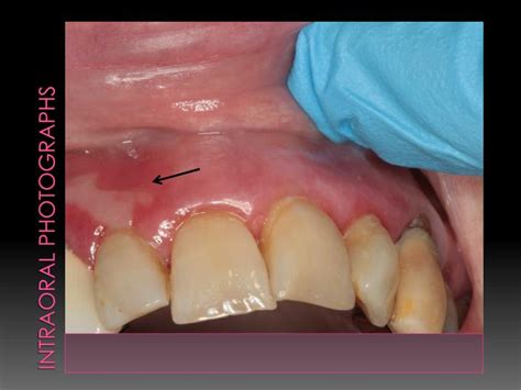 PPT - Benign Mucous Membrane Pemphigoid PowerPoint Presentation - ID:1976272