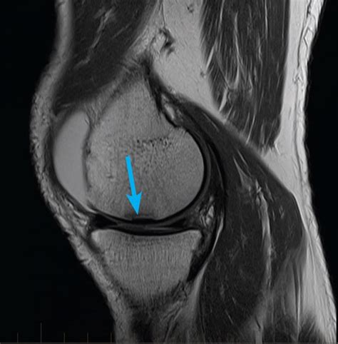 mri-knee-meniscus-tear - MRI at Melbourne Radiology Clinic